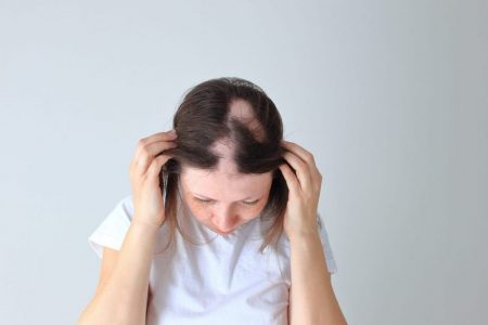 Sterk in je schoenen met Alopecia dankzij een haartopper