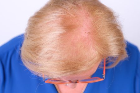 Overmatig haarverlies is vaak een signaal van je lichaam. Ontdek hier de 9 meest voorkomende oorzaken van haarverlies bij vrouwen.