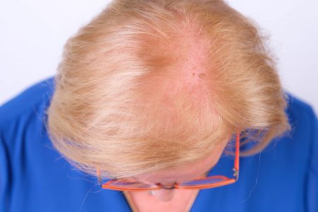 De 9 meest voorkomende oorzaken van haarverlies bij vrouwen